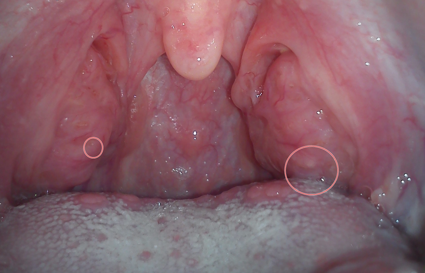 Mandelentzündung Eiter? (Gesundheit) Mandelentzündung Eiter? (Gesundheit)