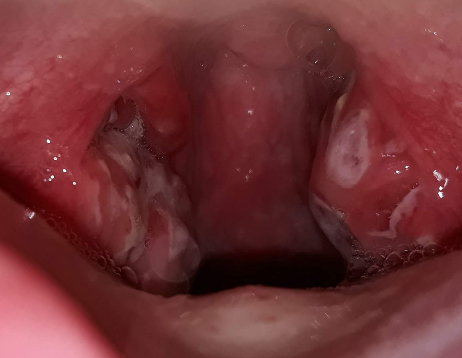 Mandelsteine Entfernen Ohne Wurgen Mandelsteine Entfernen Ohne Wurgen