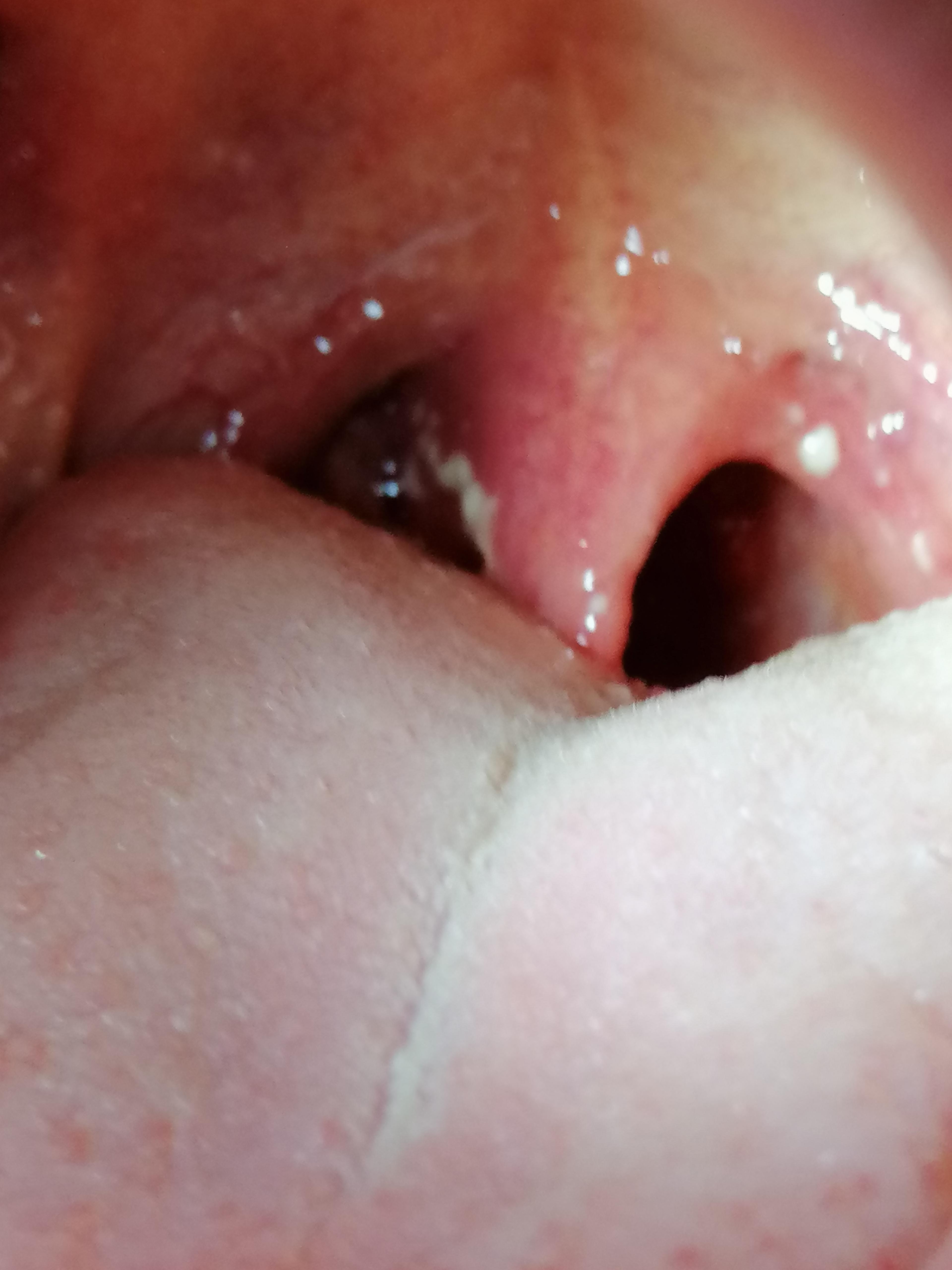 Mandelentzündung oder was könnte das sein? (Medizin, Krankheit)