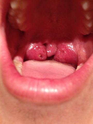 Ich Habe Locher In Meine Mandeln Ist Das Normal Sport Mandelentzundung Ich Habe Locher In Meine Mandeln Ist Das Normal Sport Mandelentzundung