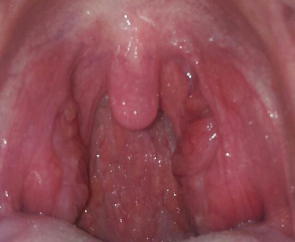 Mandeln angeschwollen kein Eiter seit c.a 5 Tagen keine Halsschmerzen Mandeln angeschwollen kein Eiter seit c.a 5 Tagen keine Halsschmerzen