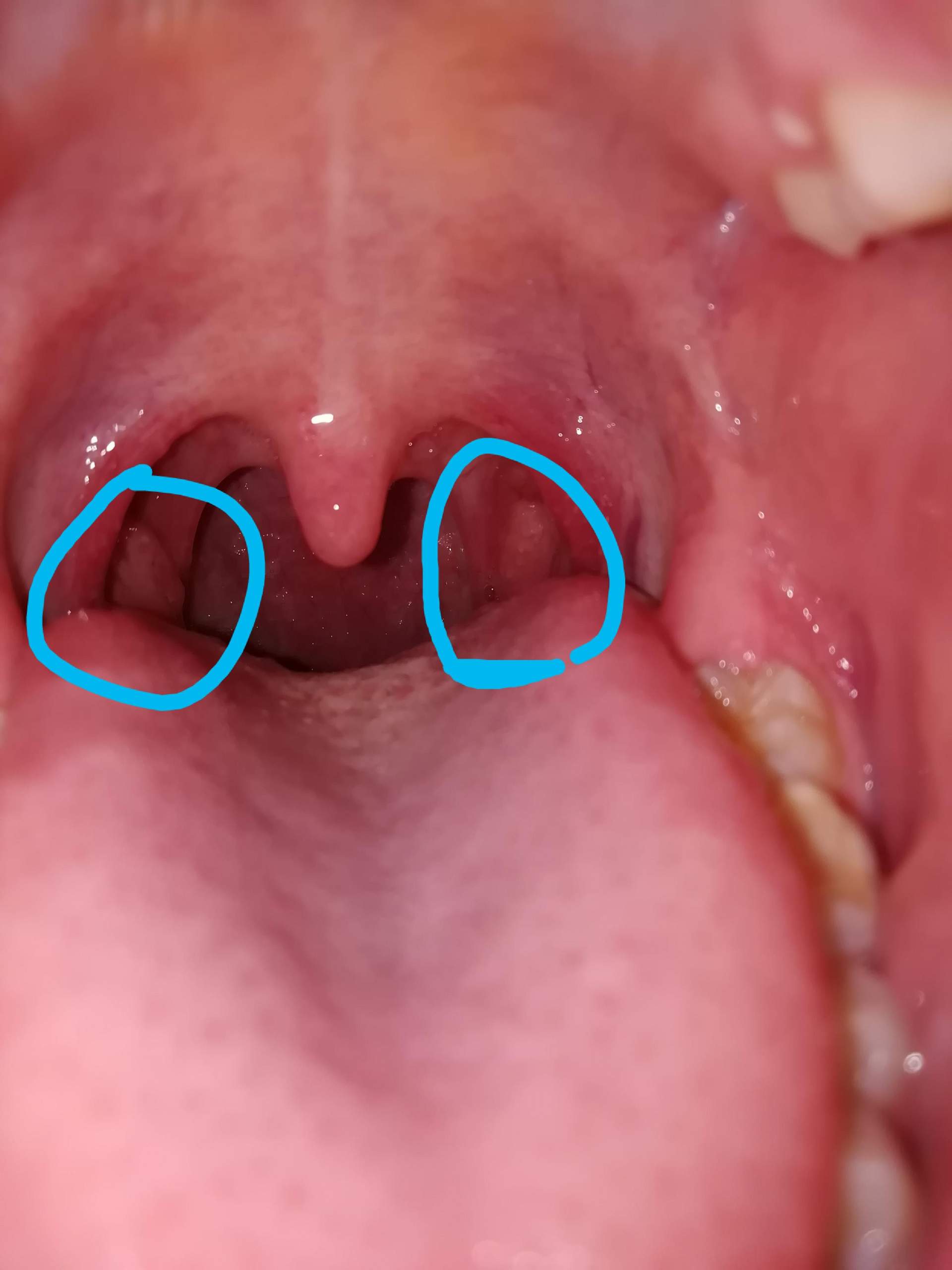 Mandeln in Hals sichtbar? (Gesundheit und Medizin, Gesundheit, Medizin)