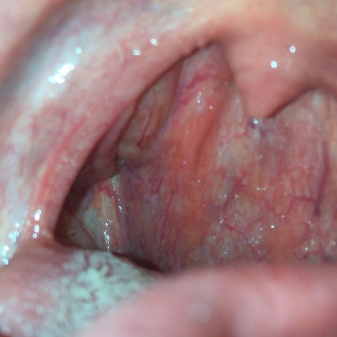 Mandeln Rachen Belag Gesundheit Hals Mandeln Rachen Belag Gesundheit Hals