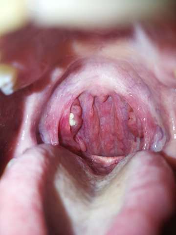 Mandelstein Ohne Wurgereiz Entfernen Gesundheit Und Medizin Gesundheit Medizin Mandelstein Ohne Wurgereiz Entfernen Gesundheit Und Medizin Gesundheit Medizin