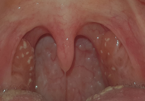 Mandelsteine Angst Vor Schlucken Mandelentzundung Schluckbeschwerden Mandelsteine Angst Vor Schlucken Mandelentzundung Schluckbeschwerden