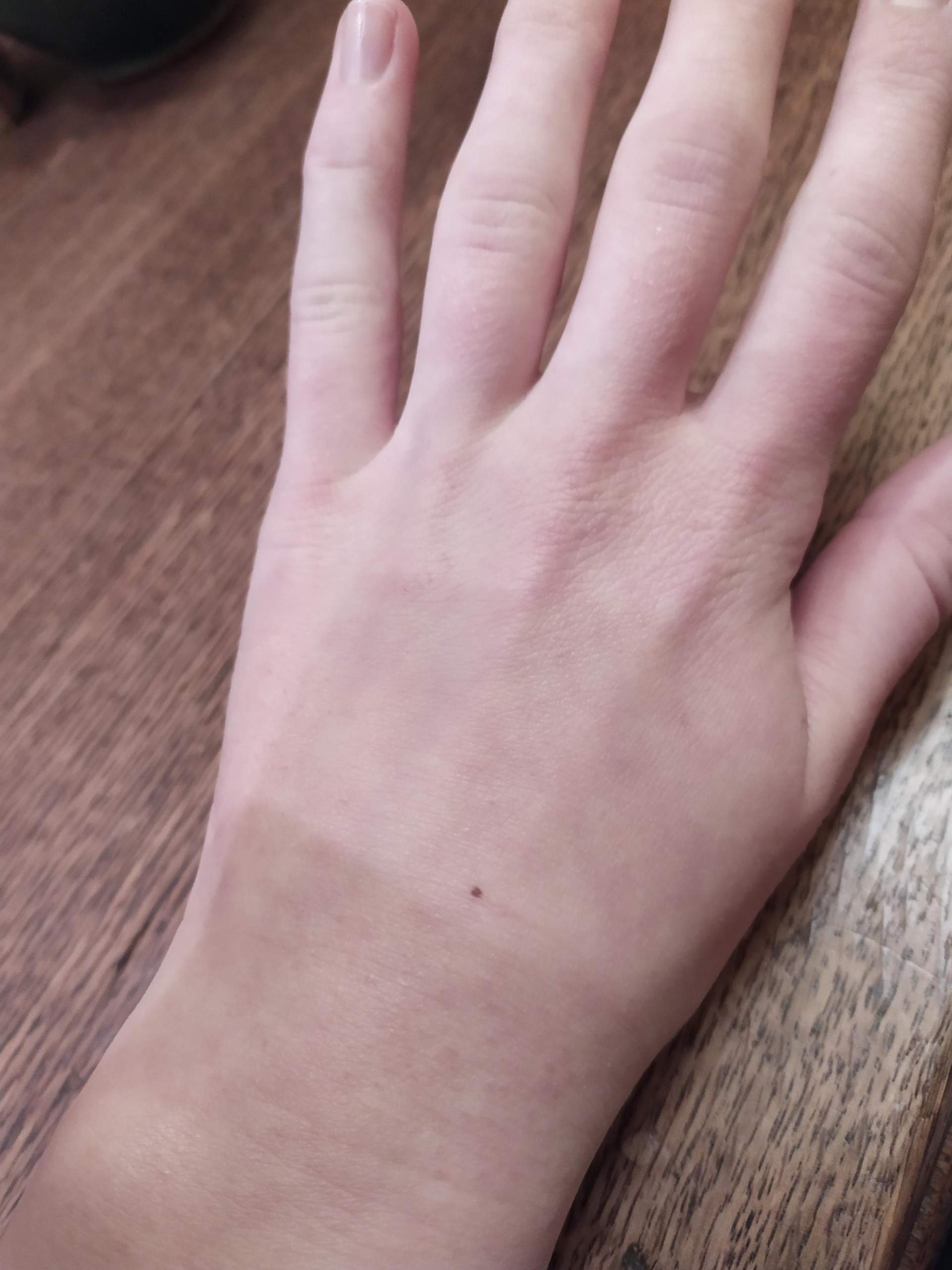 Marmorierte Haut an den Händen? (Gesundheit und Medizin, Gesundheit, Hand) Marmorierte Haut an den Händen? (Gesundheit und Medizin, Gesundheit, Hand)