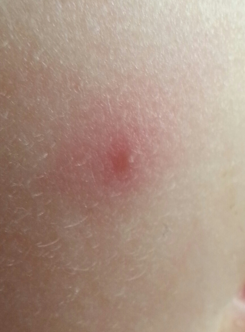 47+ Pickel An Der Lippe Kleinkind Pics