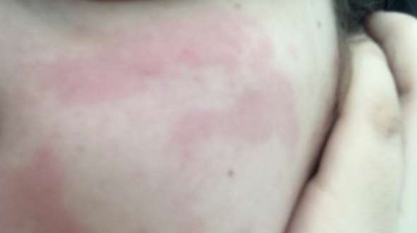 Maske Nicht Vertragen Haut Allergische Reaktion Maske Nicht Vertragen Haut Allergische Reaktion