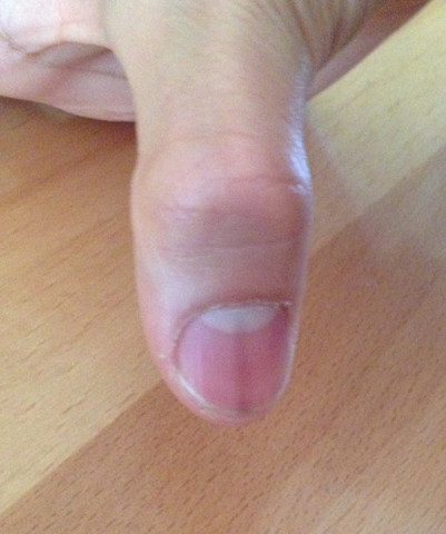 Fingernagel mit dunklem Strich  - (Gesundheit, Menschen, Finger)