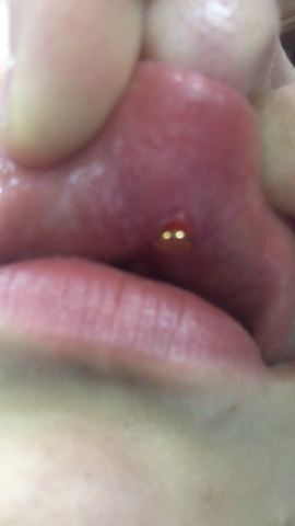 medusa piercing nach 7 monaten eiter
