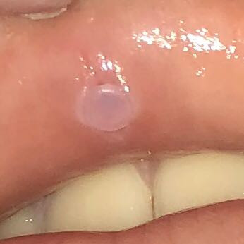 medusa piercing schneidet in die haut ein gesundheit und medizin schwellung