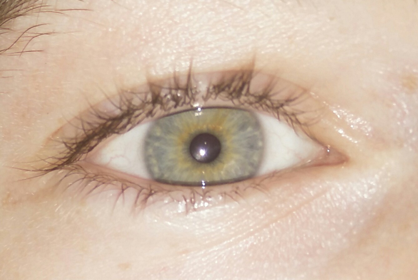 2 Augenfarben In Einem Auge