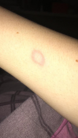 Mehrere Kleine Flecken Auf Der Haut Gehen Aber Immermal Weg Und Kommen An Anderen Stellen Wieder Jemand Ne Idee Gesundheit Mehrere Kleine Flecken Auf Der Haut Gehen Aber Immermal Weg Und Kommen An Anderen Stellen Wieder Jemand Ne Idee Gesundheit