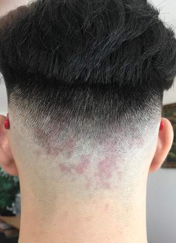 Mehrere Rote Punkte Am Hinterkopf Rote Punkte Mehrere Rote Punkte Am Hinterkopf Rote Punkte