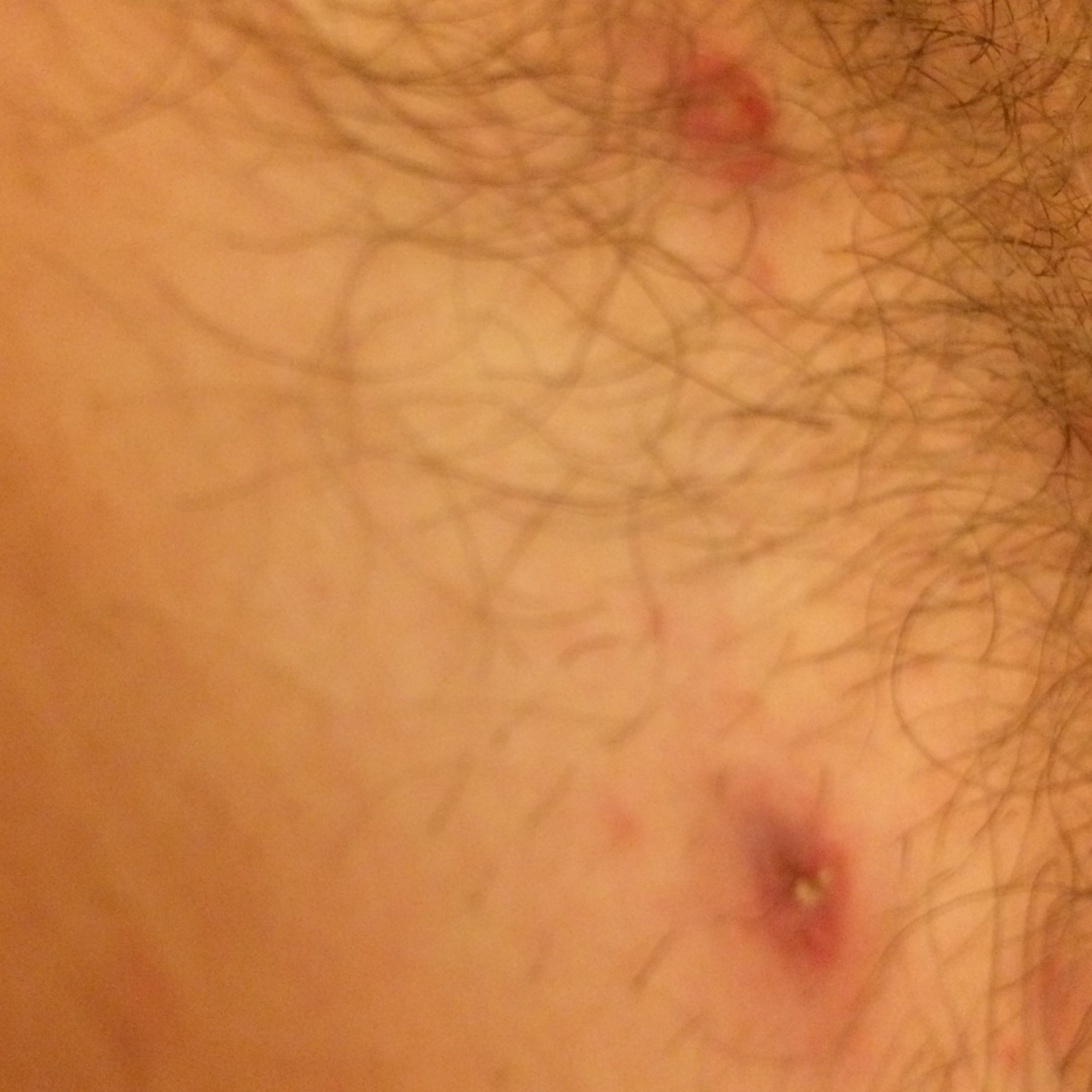 mehrere rote punkte im intimbereich