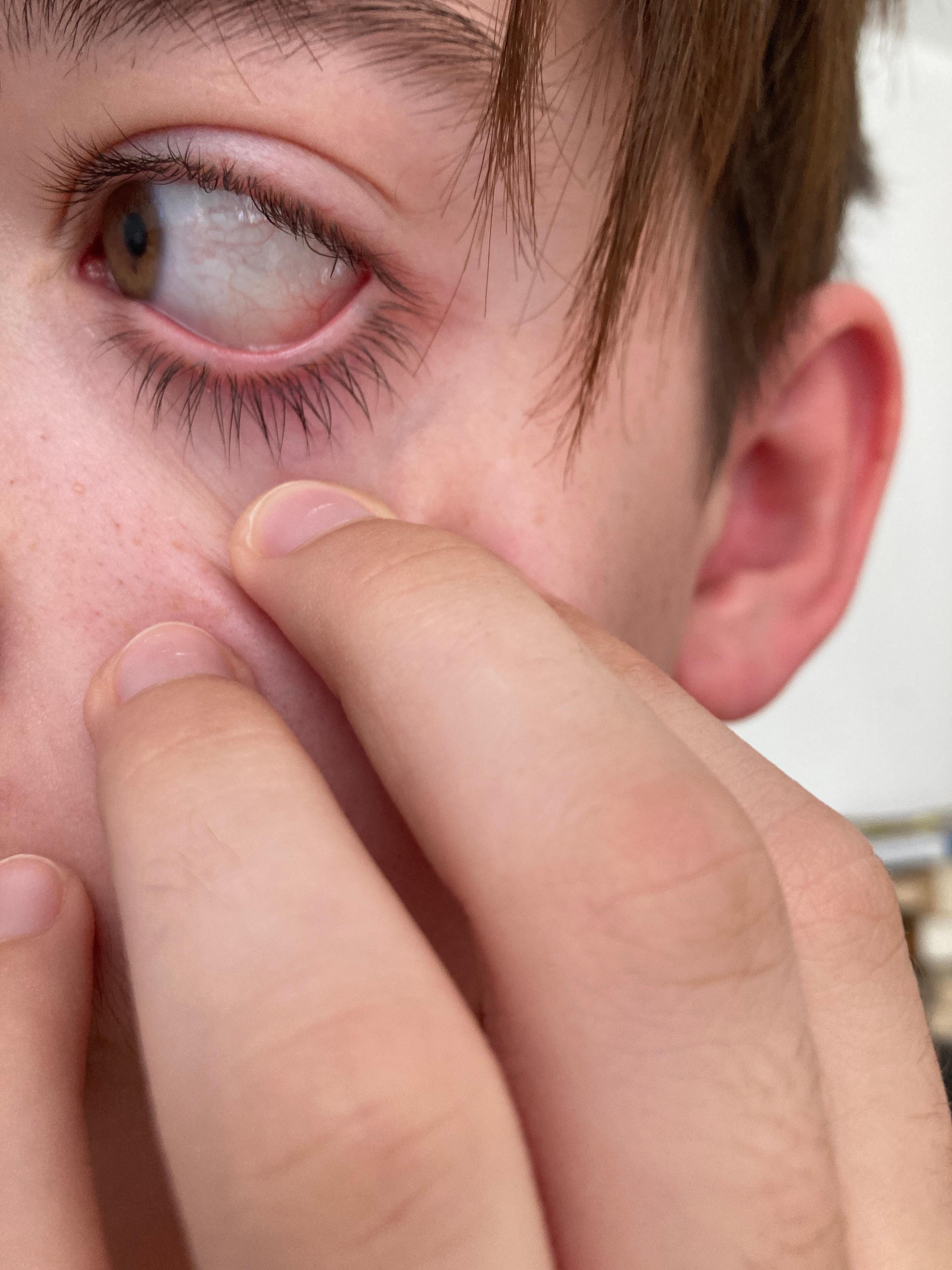 Mein Auge Ist Jedes Mal Nach Dem Aufstehen Rot Augen Rote Flecken Rote Augen Mein Auge Ist Jedes Mal Nach Dem Aufstehen Rot Augen Rote Flecken Rote Augen