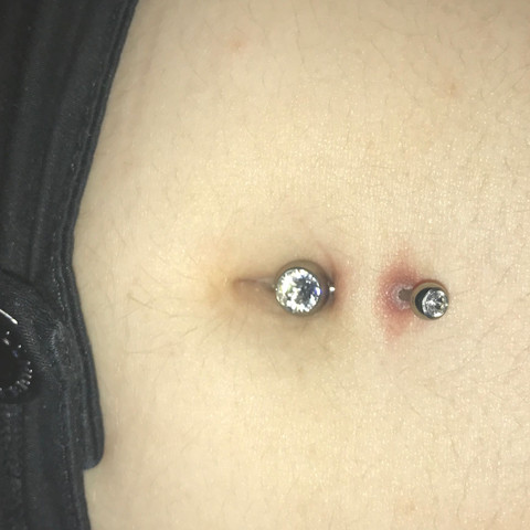Obere Einstichstelle gerötet, kleiner weisser Rand oben drauf - (EntzÜndung, Wunde, Bauchnabelpiercing)