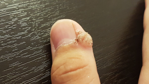 Mein Bruder Hat Am Finger Seit Uber Einem Halben Jahr Einen Auswuchs Am Daumen Aus Verhornter Haut Muss Man Da Was Unternehmen Gesundheit Mein Bruder Hat Am Finger Seit Uber Einem Halben Jahr Einen Auswuchs Am Daumen Aus Verhornter Haut Muss Man Da Was Unternehmen Gesundheit