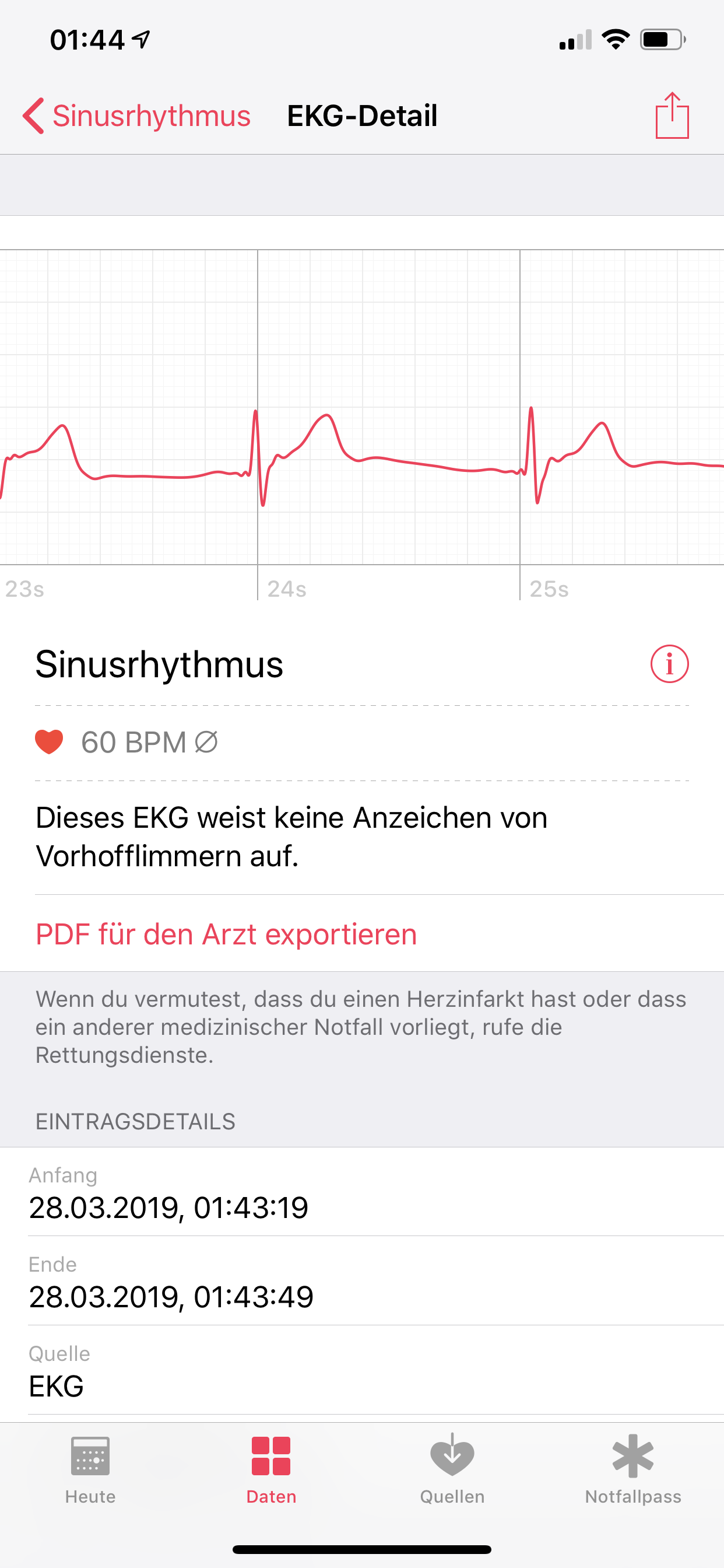 Mein Ekg Ist Auffallig Habe Ich Eine Zu Hohe T Welle Gesundheit Und Medizin Arzt Physik