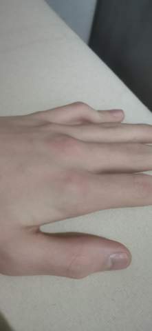 Mein finger ist krumm wenn ich meine Hand normal hinlege?