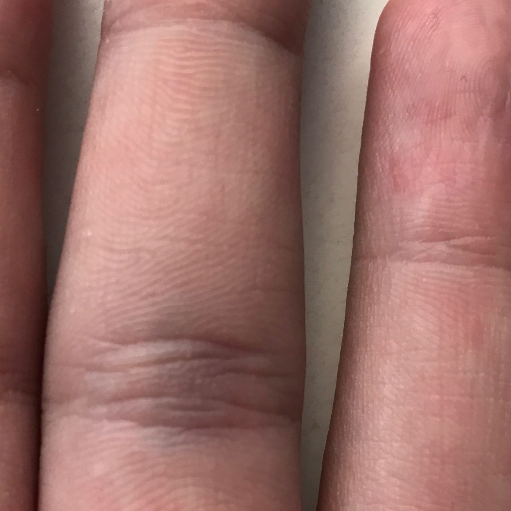 Mein Finger Tut Bei Jeder Bewegung Weh Was Heisst Das Schmerzen Doktor Bluterguss