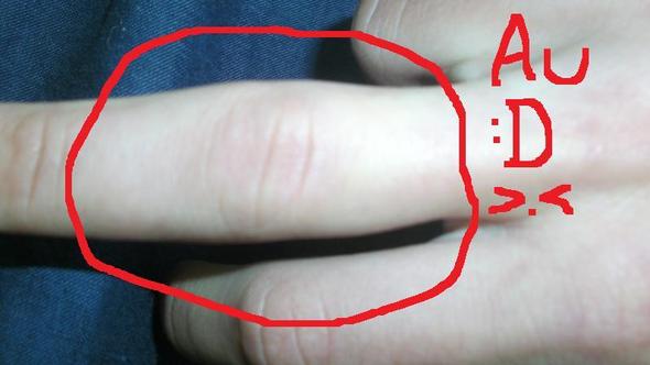 Geschwollener Finger - rechte Hand - (Medizin, Verletzung, Hand)