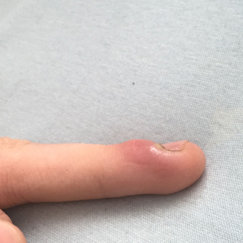Ringfinger  - (Schmerzen, Finger)