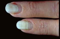 Wächst nicht nach fingernagel Geklemmter Fingernagel