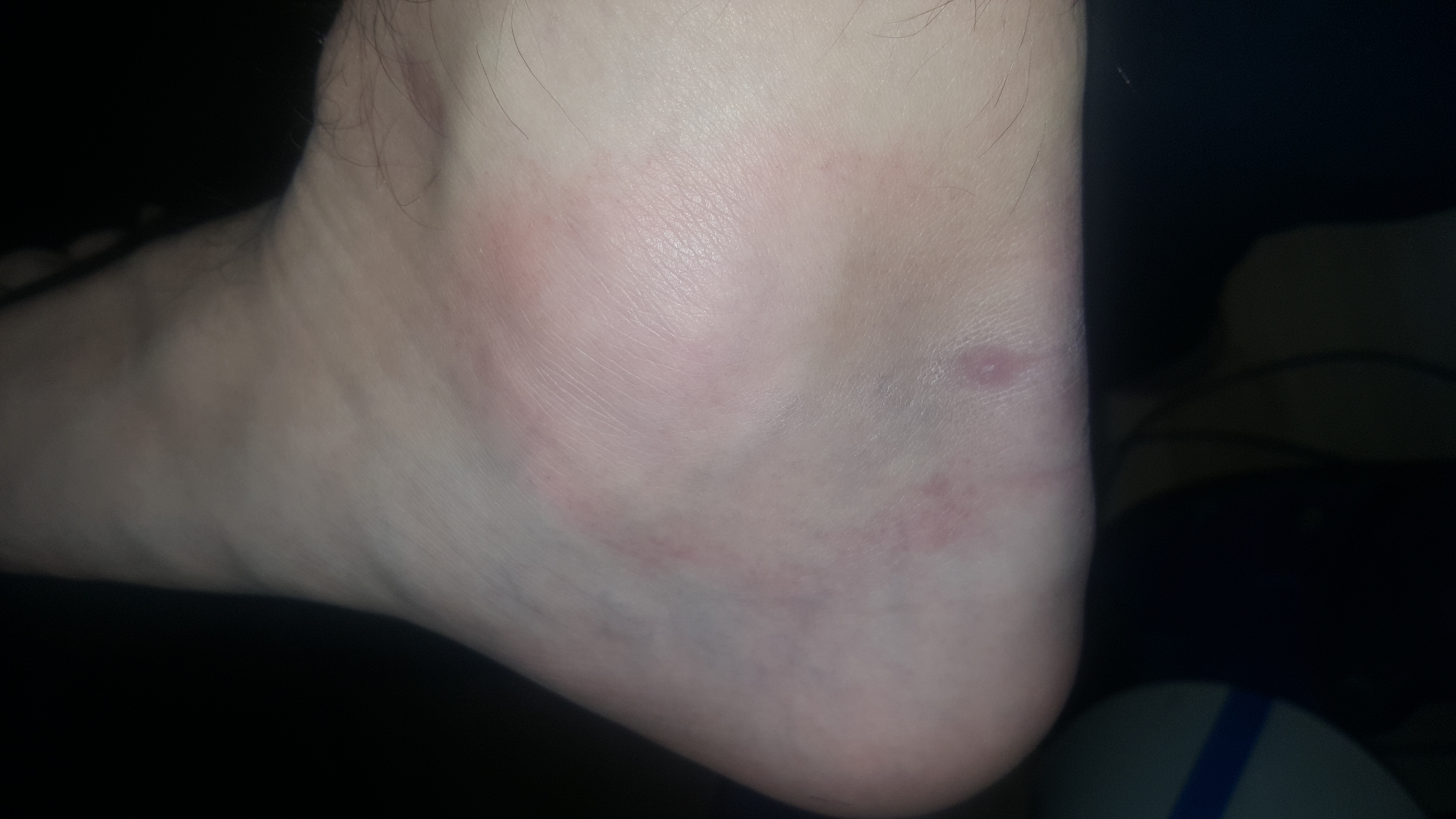 Warum hat mein Fuß rote flecken? (Gesundheit, Haut, Allergie) Warum hat mein Fuß rote flecken? (Gesundheit, Haut, Allergie)