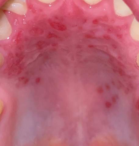 Gaumen Die Meistgelesenen Fragen Gaumen Die Meistgelesenen Fragen