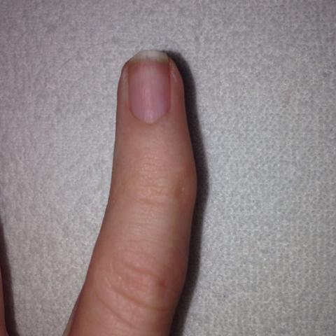 Mein Kleiner Finger Ist Krumm Was Kann Ich Dagegen Tun Korper Arzt Op Mein Kleiner Finger Ist Krumm Was Kann Ich Dagegen Tun Korper Arzt Op