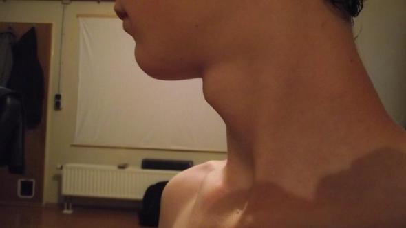 Mein Kropf Ist Sehr Stark Zu Sehen Schilddruse Kropf Korper Krankheit Thyroxin Mein Kropf Ist Sehr Stark Zu Sehen Schilddruse Kropf Korper Krankheit Thyroxin