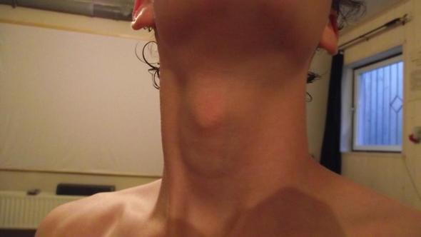 Mein Kropf Ist Sehr Stark Zu Sehen Schilddruse Kropf Korper Krankheit Thyroxin Mein Kropf Ist Sehr Stark Zu Sehen Schilddruse Kropf Korper Krankheit Thyroxin