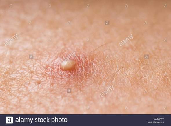 Download Pickel Ausdrücken Eiter Und Blut PNG