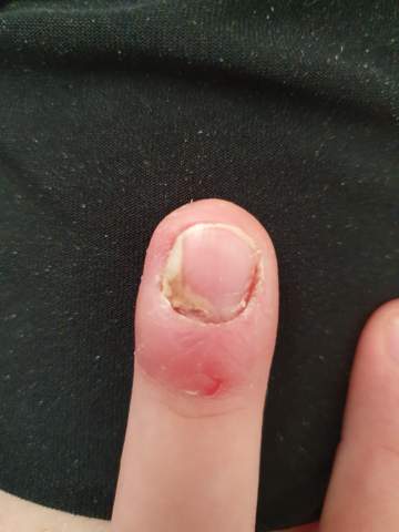 mein nagel lost sich gesundheit und medizin nagel fingernagel