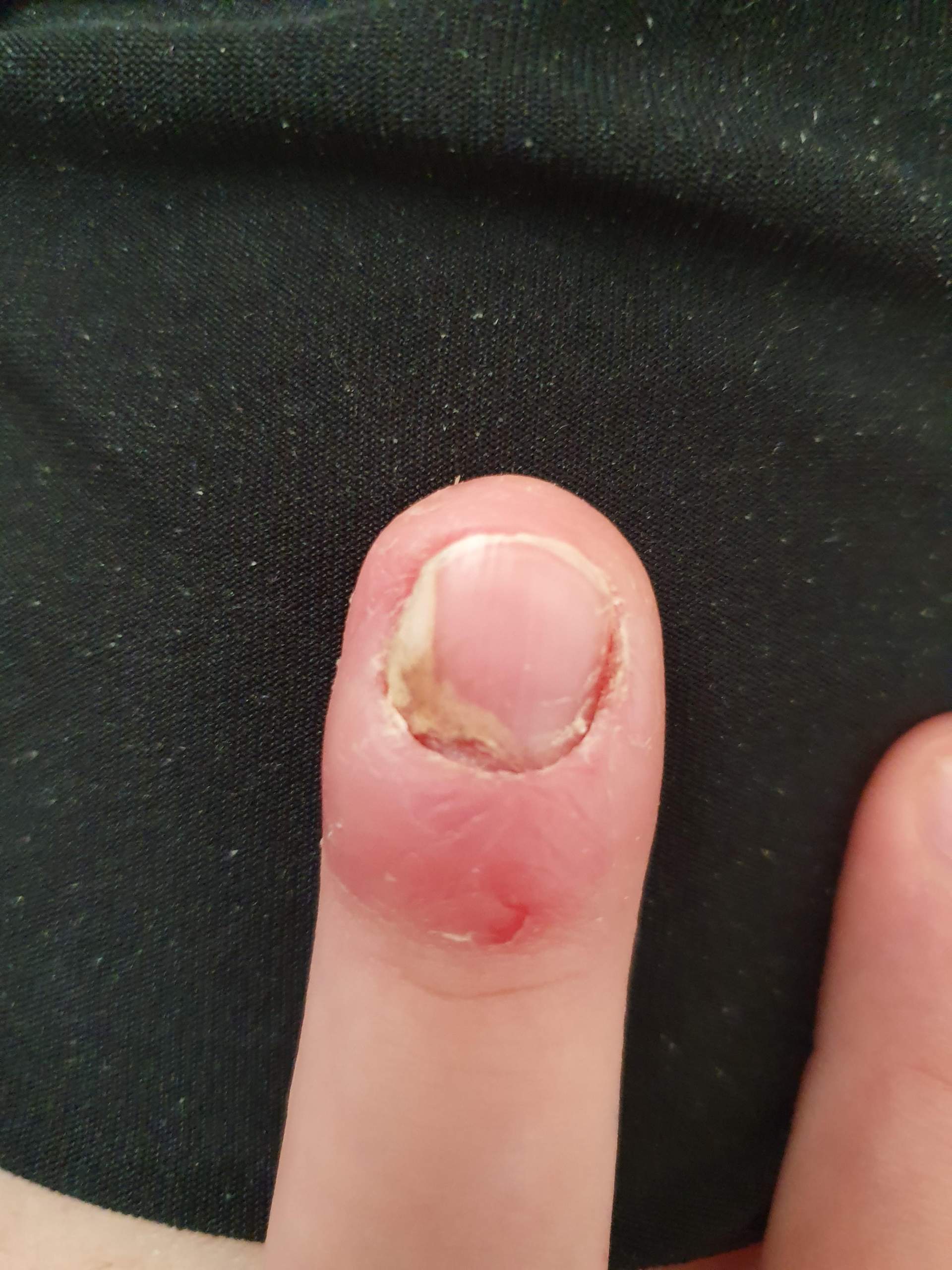 Mein Nagel löst sich?!? (Gesundheit und Medizin, Nägel, Fingernägel)
