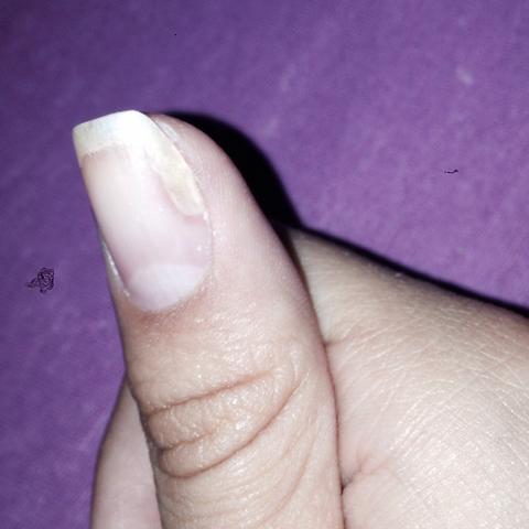 Mein Nagel Wachst Komisch Was Tun Nagel Wachsen Mein Nagel Wachst Komisch Was Tun Nagel Wachsen
