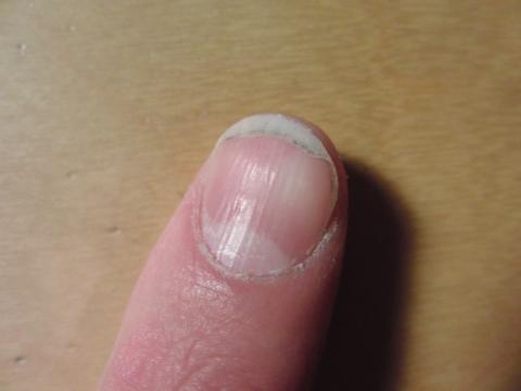 Mein Nagelbett Ist Zu Weit Nach Hinten Geschoben Siehe Bild Nagel Fingernagel Nagelpflege