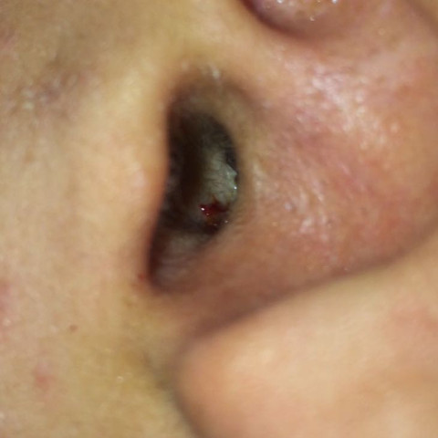 Mein Ohr Blutet Schlimm Gesundheit Ohrenentzundung Mein Ohr Blutet Schlimm Gesundheit Ohrenentzundung