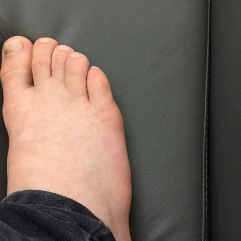 Fuß geschwollen gicht Gichtanfall: Symptom,