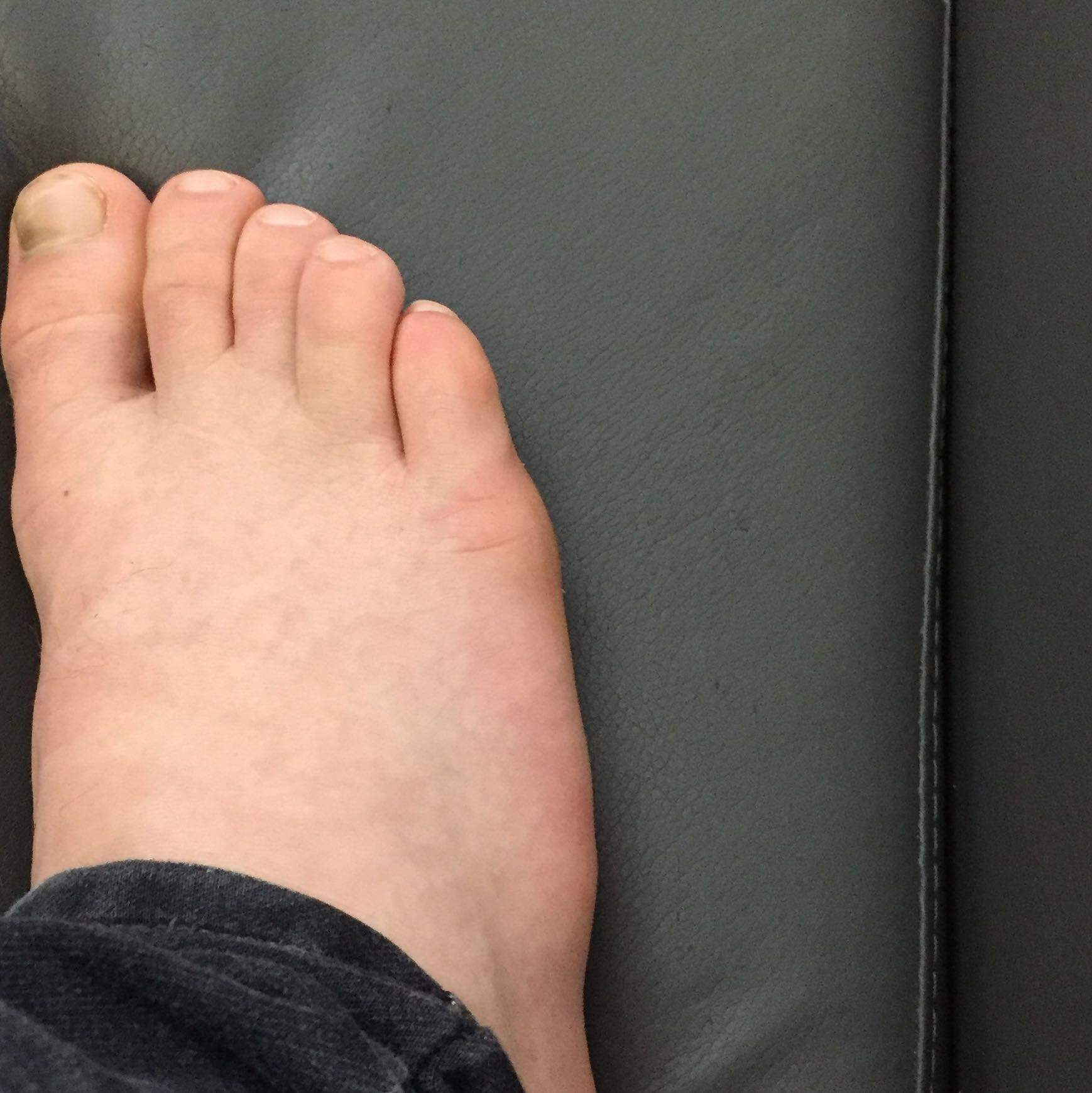 Scheibefuss Brachydaktylie Am Fuß Symptome – WACX