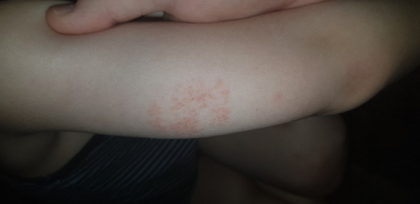 Mein Sohn Hat Auf Den Armen Stellen Mit Trockener Haut Kann Jemand Anhand Des Bildes Genaueres Sagen Ist Es Vielleicht Nichts Ungewohnliches Bei Kinder Hautkrankheit Ekzem Kinderkrankheiten