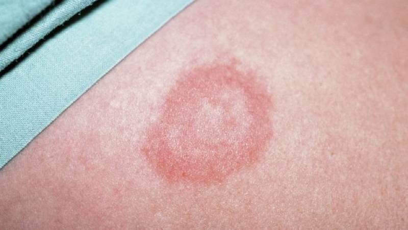 Mein Vater hat Hautausschlag er wurde vor paar Monaten (fast ein Jahr Mein Vater hat Hautausschlag er wurde vor paar Monaten (fast ein Jahr