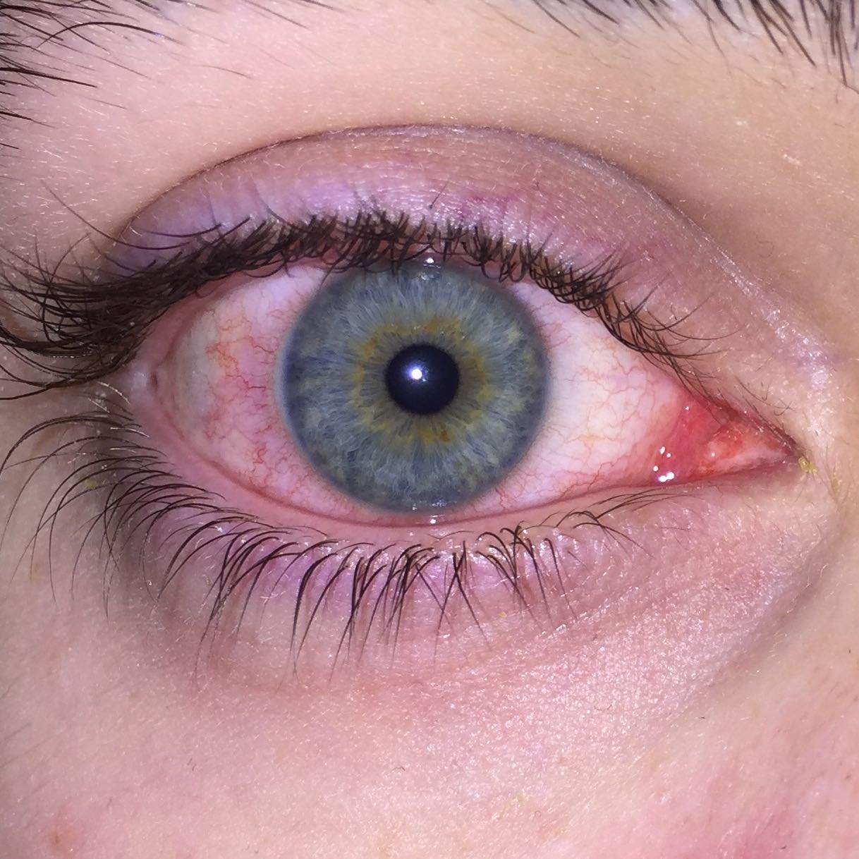 Meine Auge ist rot was tun? (Medizin, Augen, Entzündung)