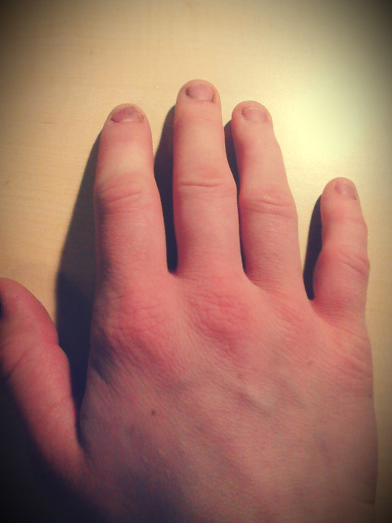 Meine Finger jucken und sind geschwollen. (Hand, Juckreiz) Meine Finger jucken und sind geschwollen. (Hand, Juckreiz)