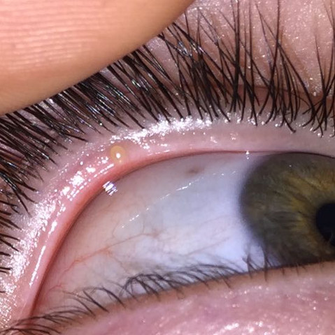 Meine Freundin Hat Ein Gerstenkorn Gesundheit Augen Meine Freundin Hat Ein Gerstenkorn Gesundheit Augen