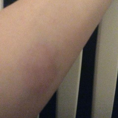 Mein Arm von grad eben (is in echt viel dunkler) tut seit heut Vormittag so weh - (Mädchen, Arm, blau)