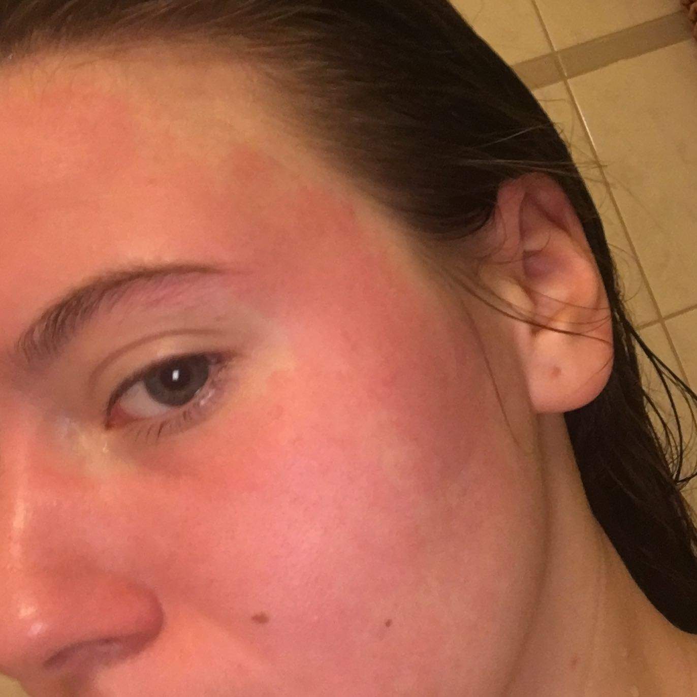 Plötzlich Rotes Gesicht Und Heiß