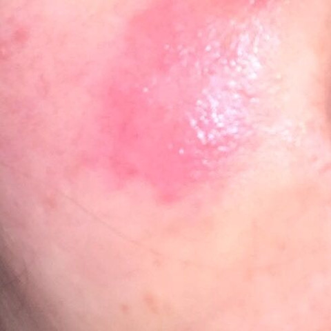 Meine Gesichtshaut Ist Rot Geschwollen Juckt Und Brennt Was Soll Ich Tun Angst Reaktion