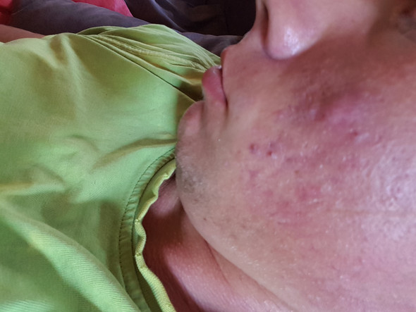 - (Gesundheit und Medizin, Haut, Pickel)